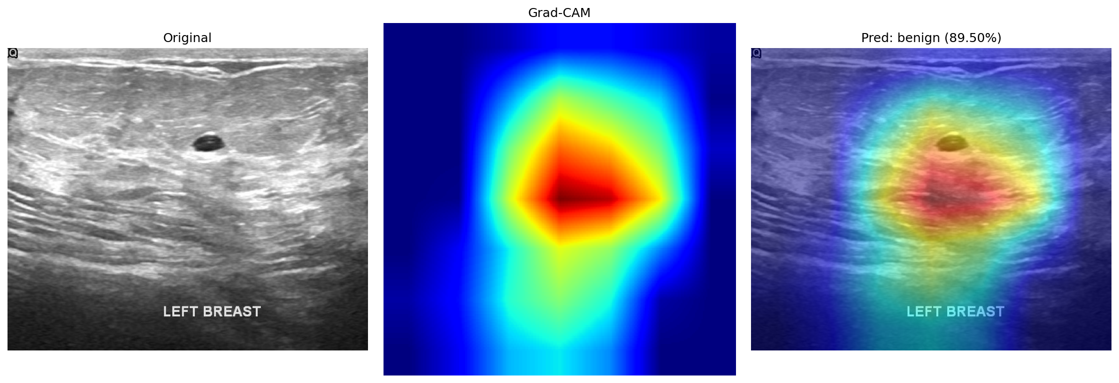 Grad-CAM on a benign case