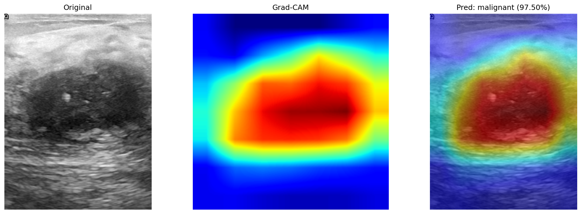 Explainable AI for breast cancer detection