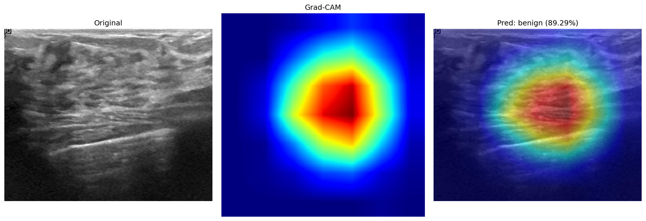 Grad-CAM on a normal case